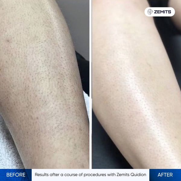 Zemits Quidion Diode Laser For Hair Removal